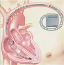 細(xì)數(shù)心臟起搏器和ICD之間的差異 細(xì)數(shù)心臟起搏器和ICD之間的差異